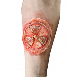 Radioactive wound