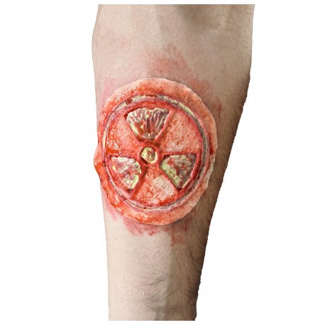 Radioactive wound