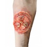 Radioactive wound